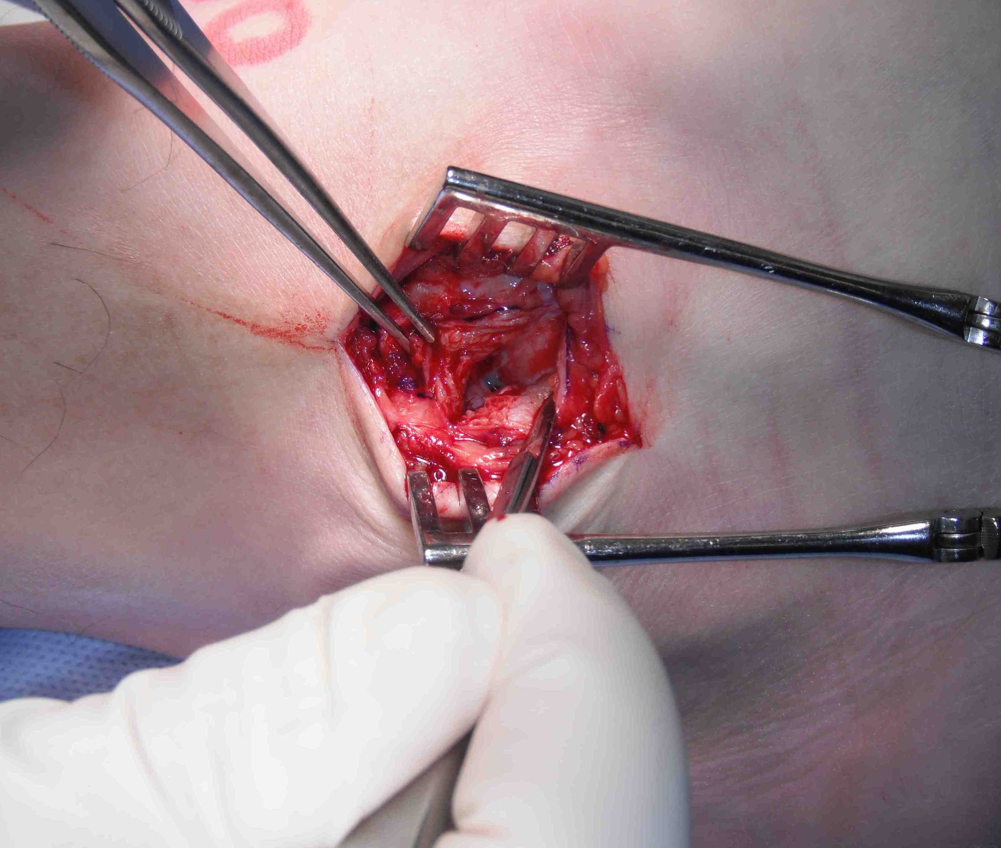 First Transverse Incision
